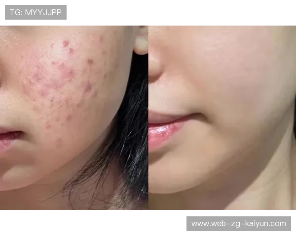 运动与痘痘：为什么运动后长痘，为什么运动完后痘痘变明显了